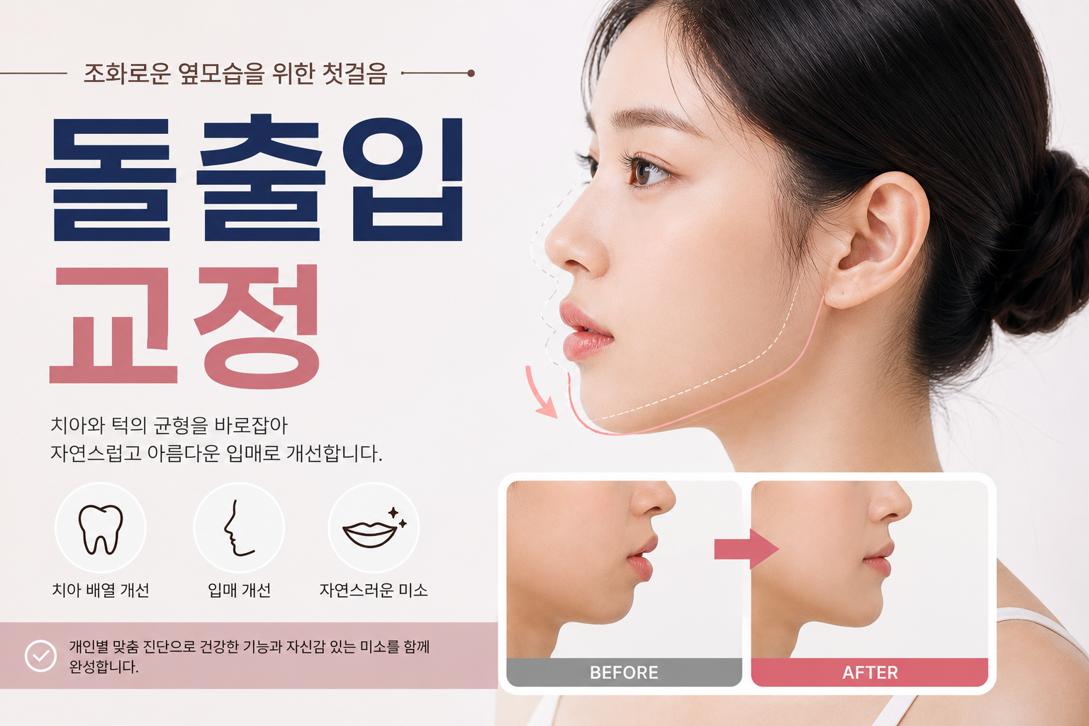 돌출입교정의 예