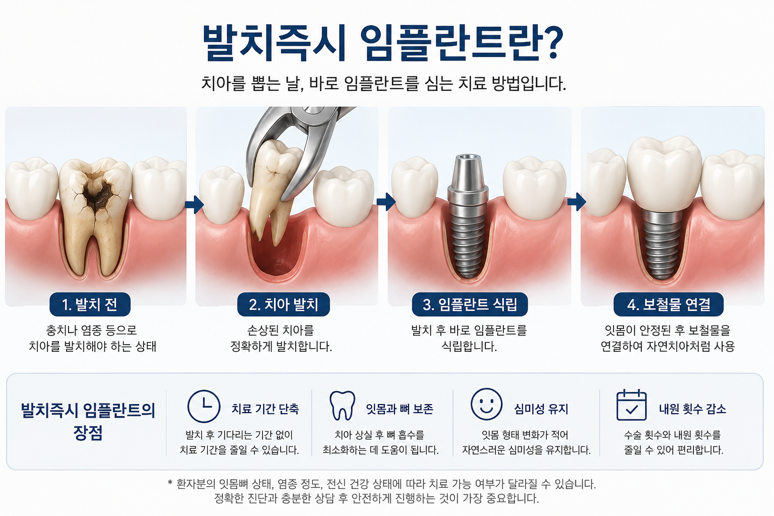 발치즉시 임플란트, 치아를 뽑는 날 바로 심을 수 있을까요?