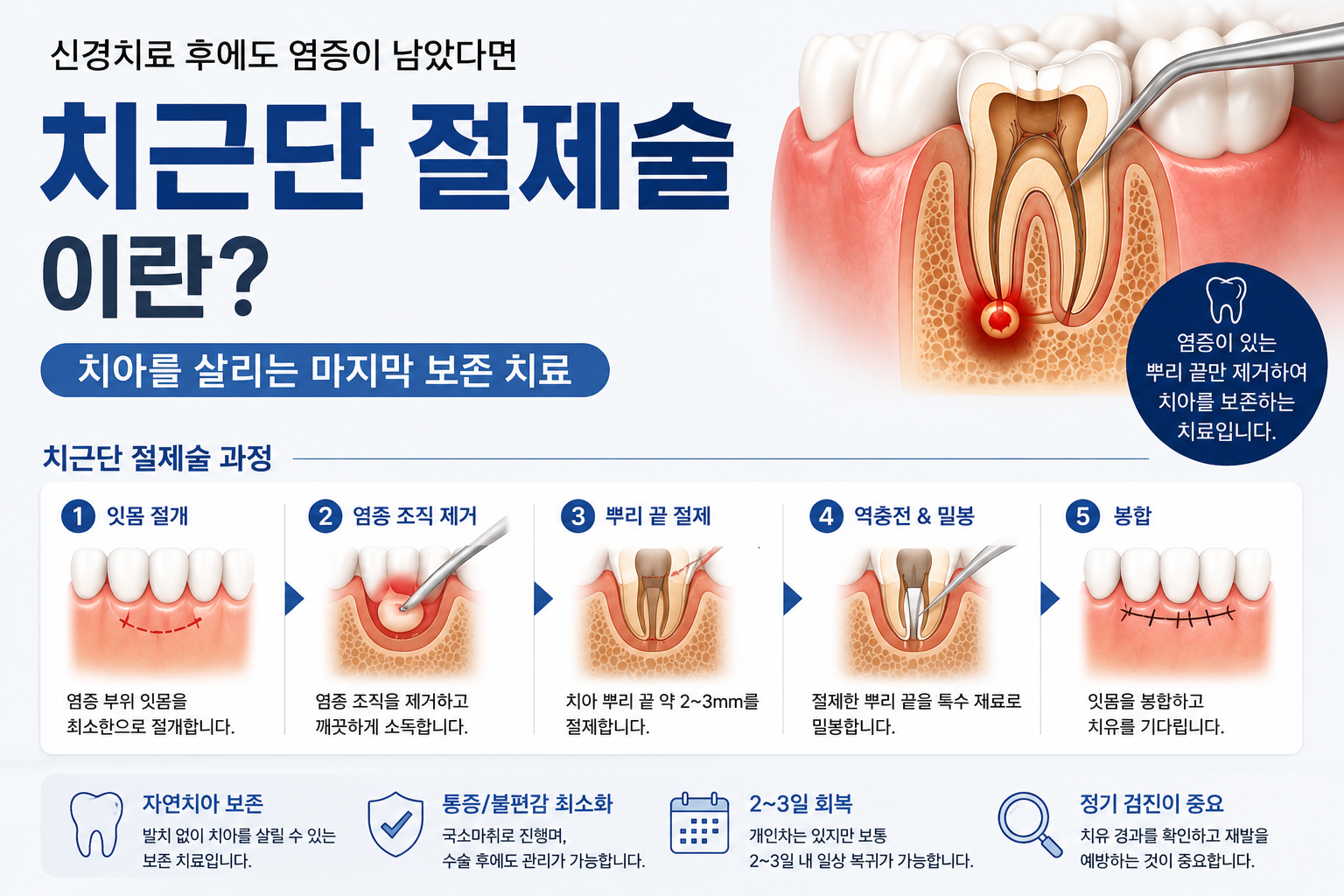 치근단 절제술에 대한 설명