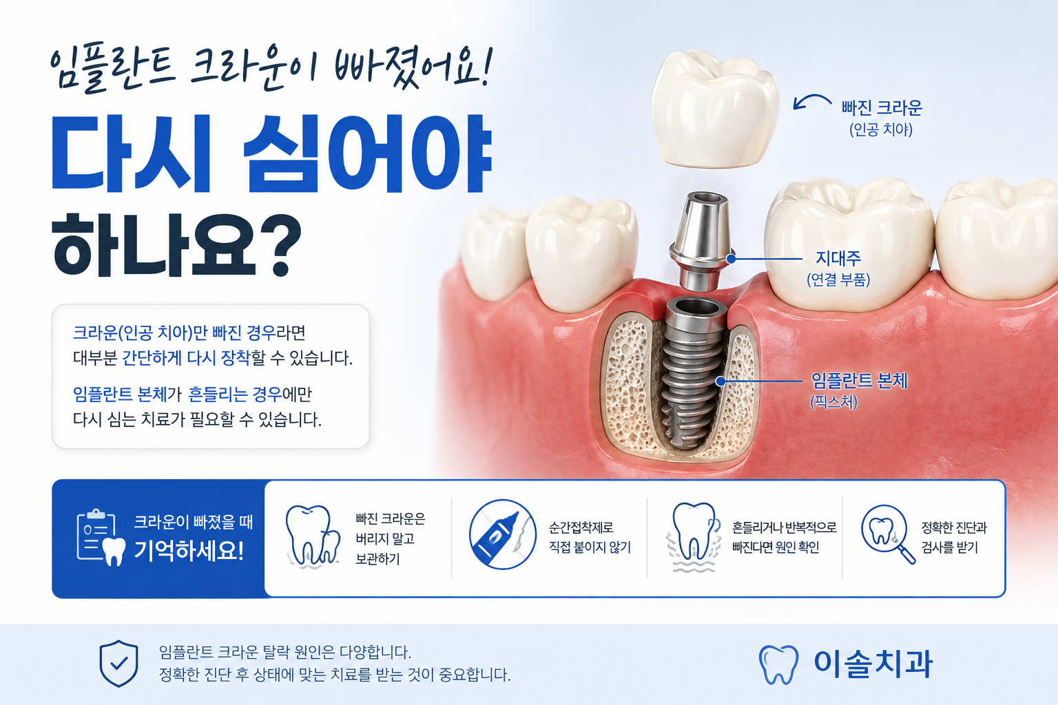 임플란트 크라운 탈락에 대한 설명
