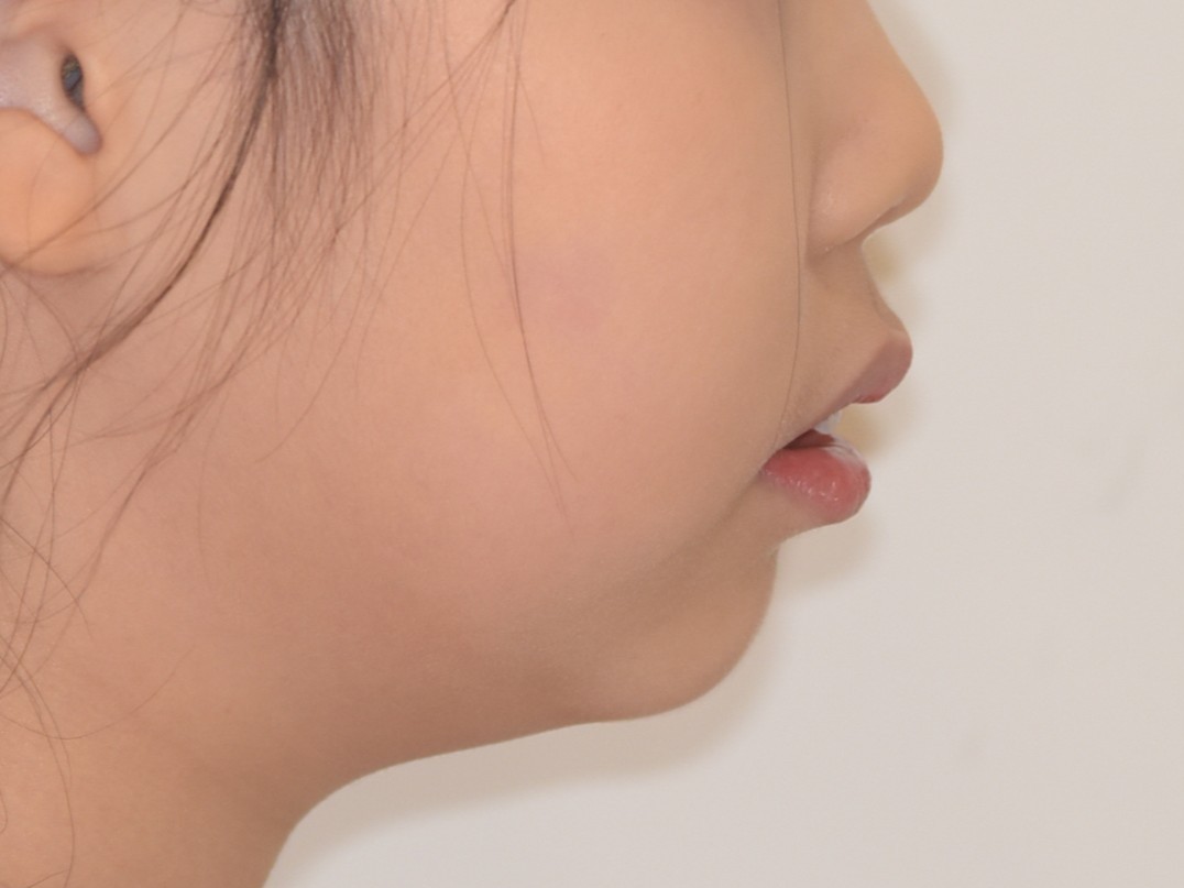 구내 포토 전후 치료 전
