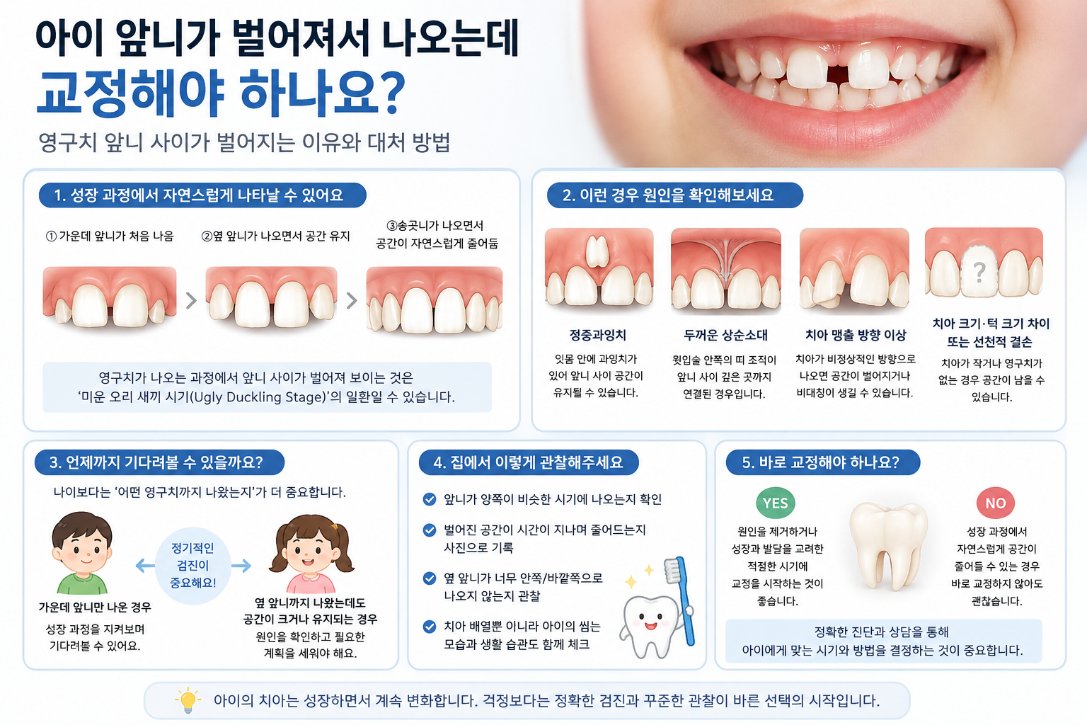 앞니 벌어짐에 대한 설명