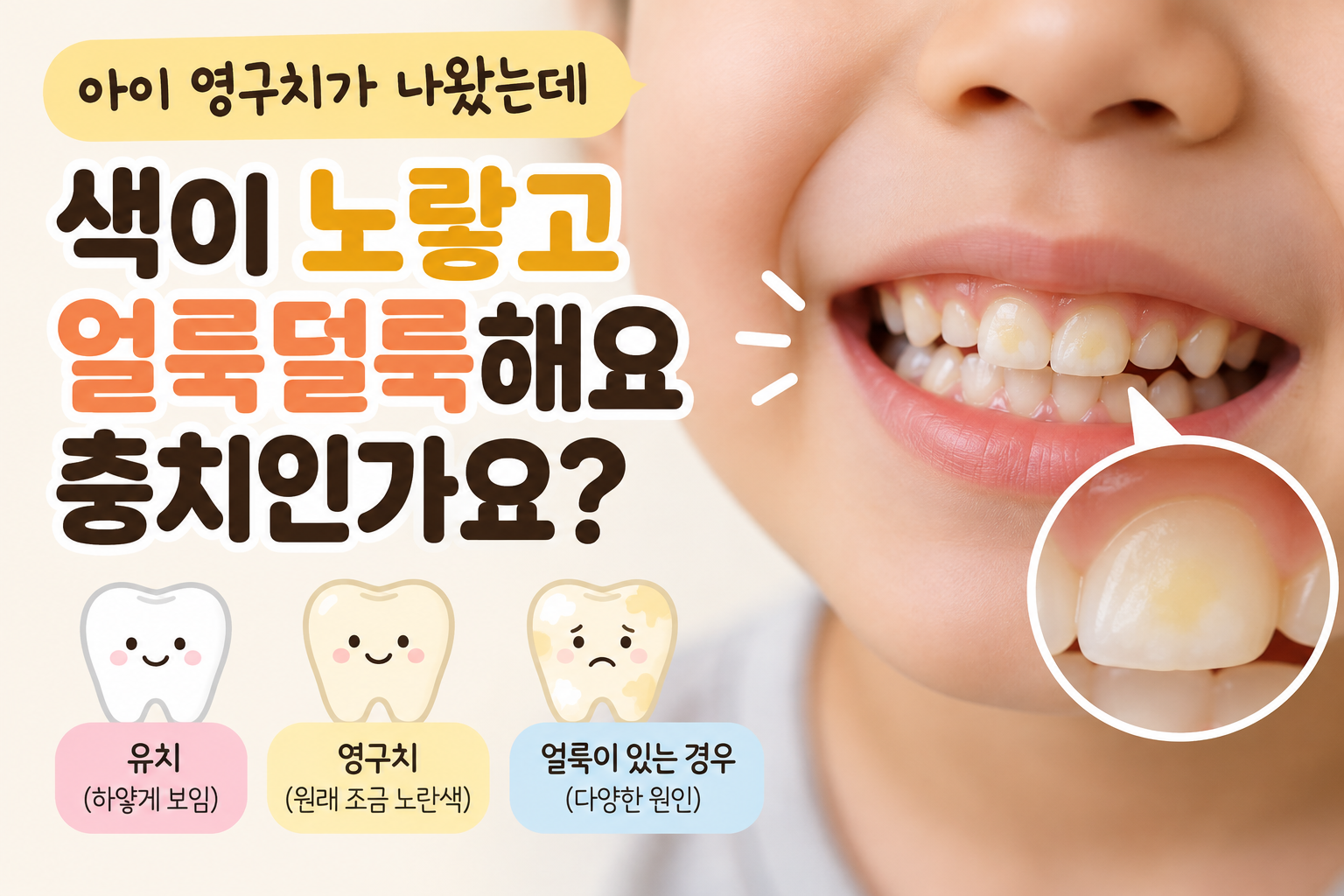 아이 영구치가 나왔는데 색이 노랗고 얼룩덜룩해요, 충치인가요?
