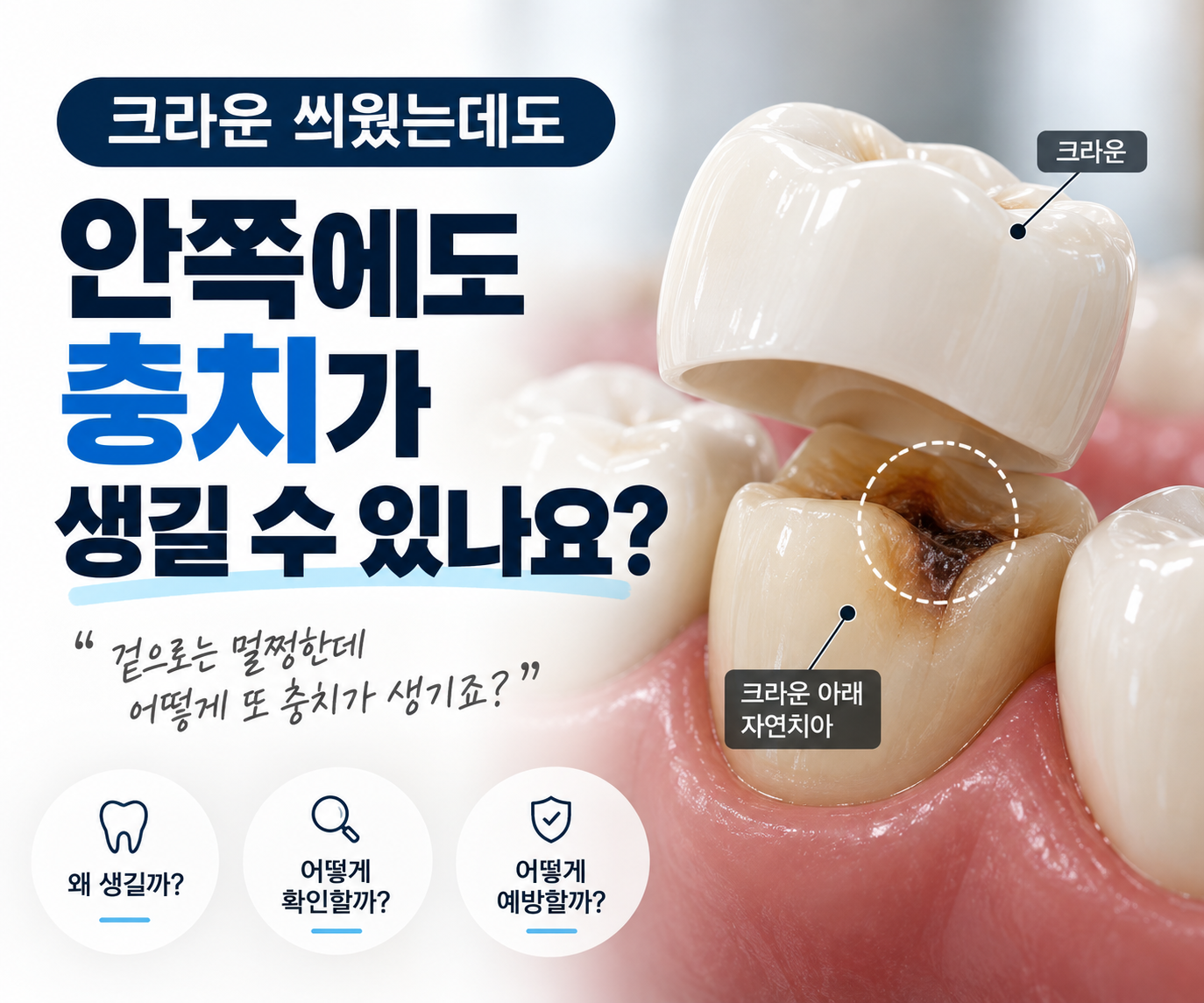 크라운 안쪽에도 충치가 생길 수 있나요? 원인과 확인법