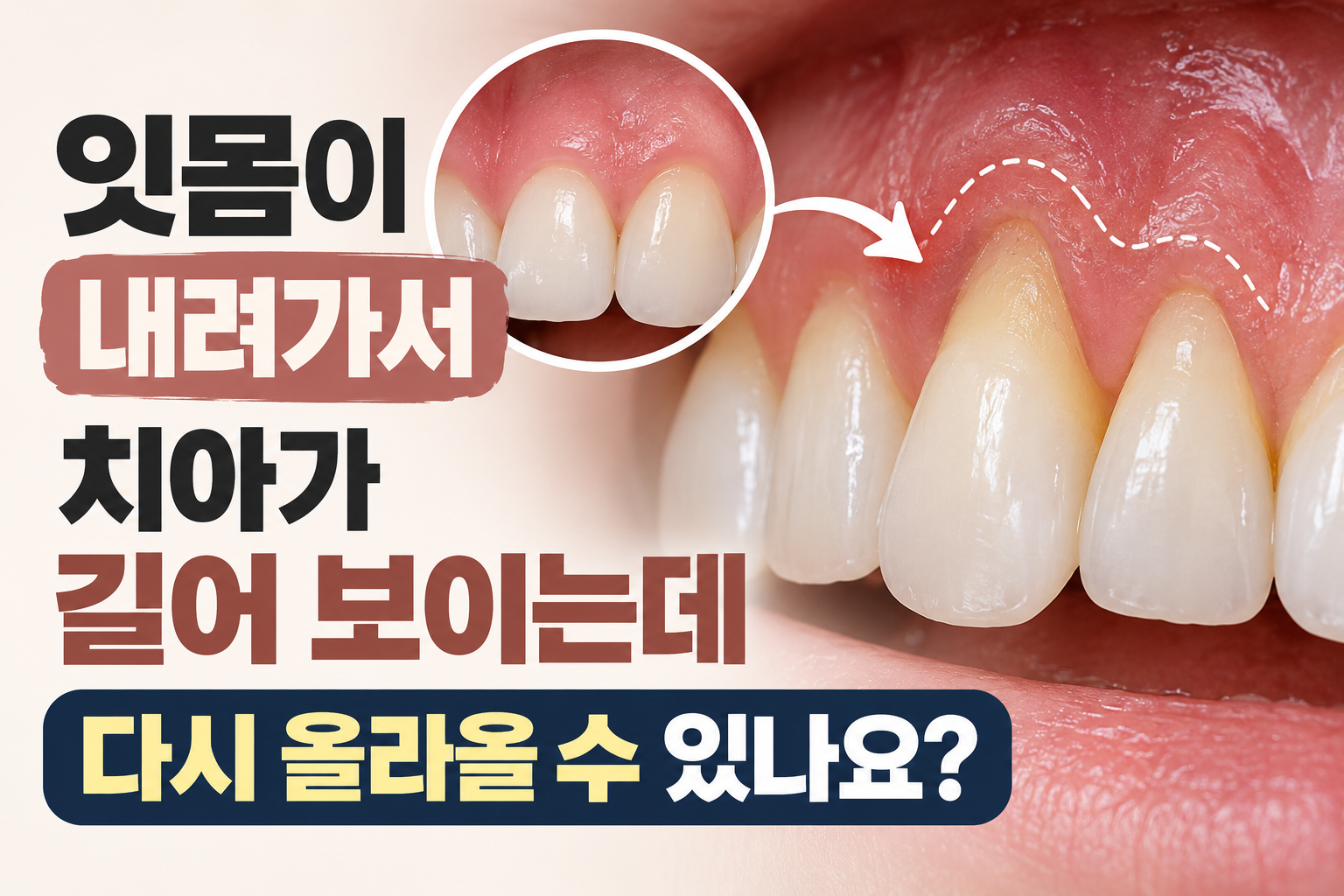 잇몸이 내려가면 다시 올라올 수 있나요?