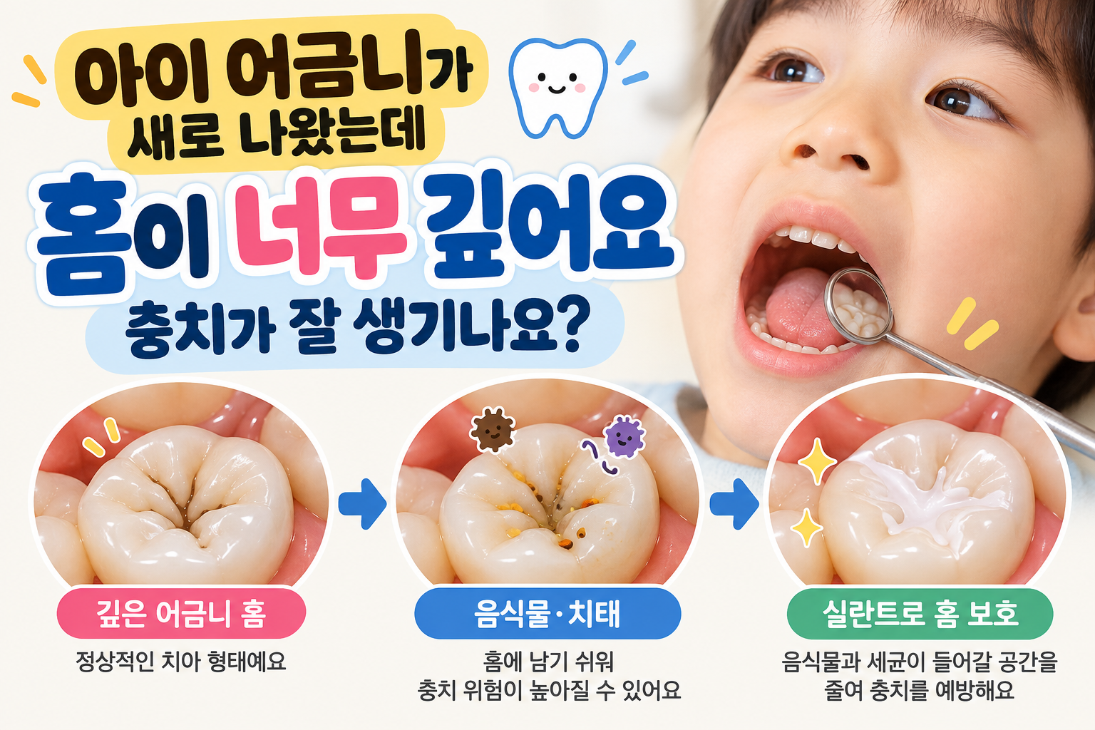 아이 어금니 홈이 깊으면 충치가 잘 생기나요?